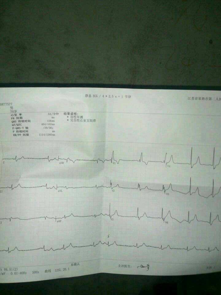 若何看心电图(心电图怎么看算一般)