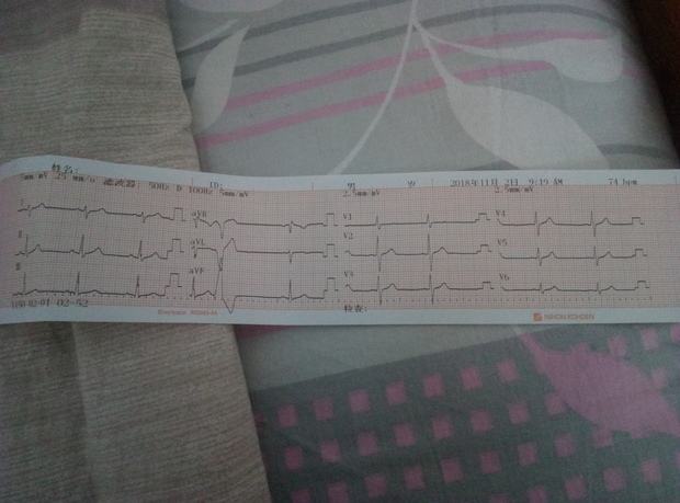 若何看心电图(心电图怎么看算一般)