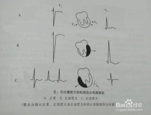 怎么看心电图(心电图怎么看图解) 怎么看心电图(心电图怎么看图解)