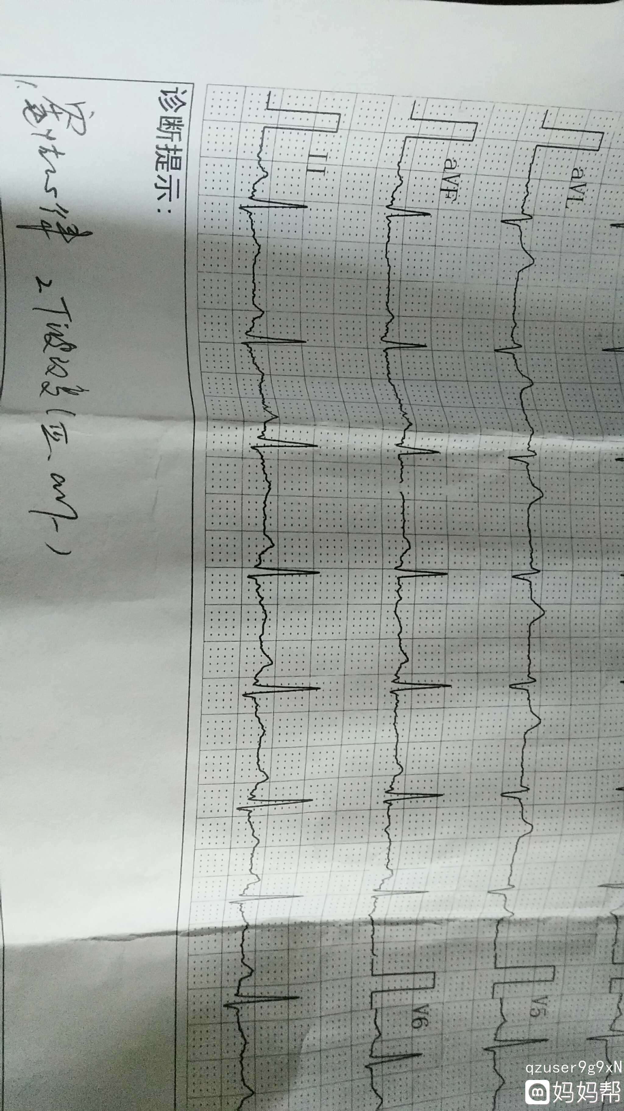 若何看心电图(若何看心电图视频教程) 若何看心电图(若何看心电图视频教程)